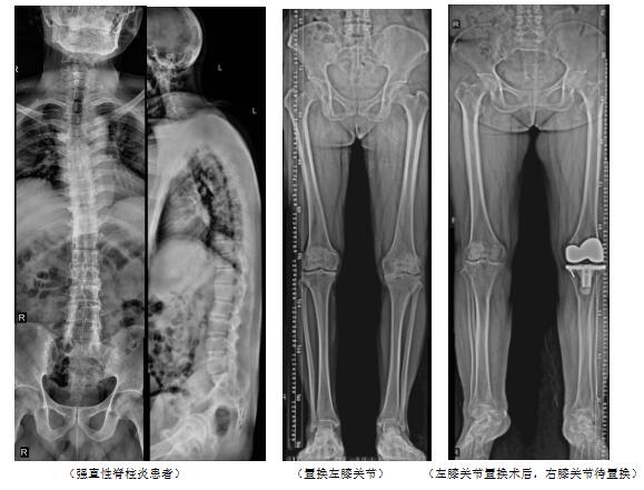 保山市中医医院放射科率先在全市开展全脊柱和下肢全长拼接检查技术(图1)