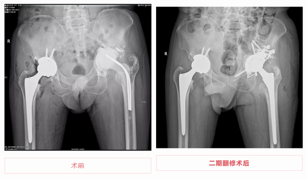 保山市中医医院骨伤科成功开展复杂型髋关节置换术后二期翻修术(图1)